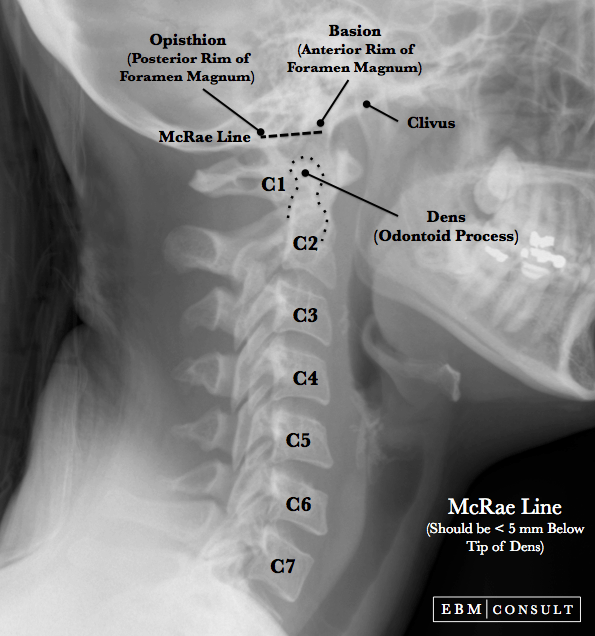 McRae Line on Lateral CSpine XRay, CT or MRI